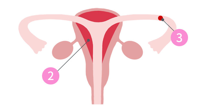 5：子宮内膜が厚くなる